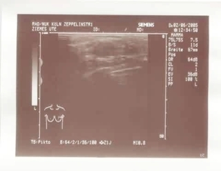 Ultraschallbild meiner linken Brust kurz vor der OP
